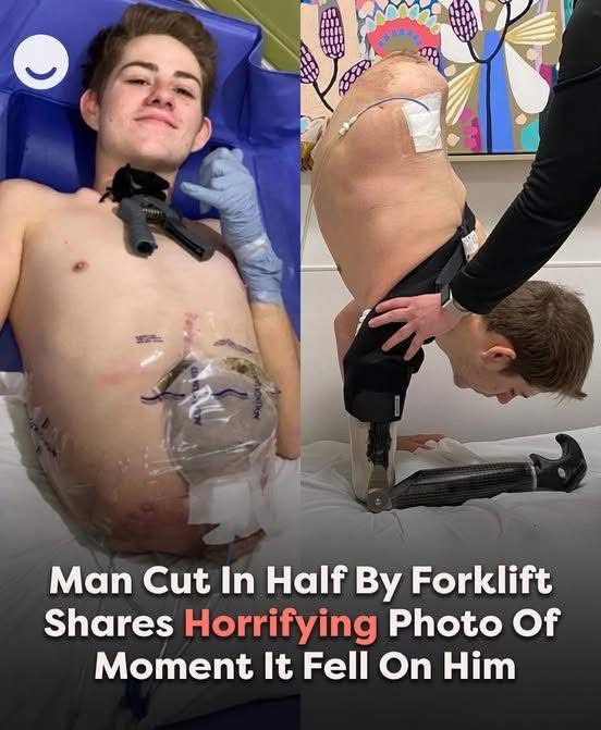 Man Cut In Half By Forklift Shares Horrifying Photo Of Moment It Fell On Him