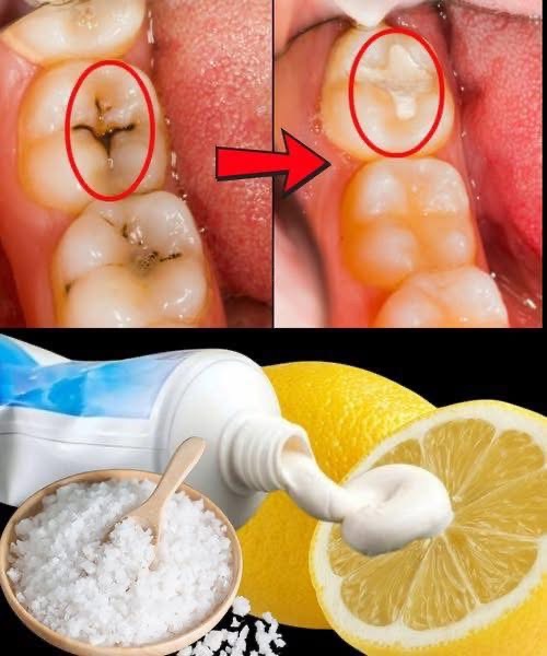 Heal Early Cavities Naturally: 6 Powerful Tips To Protect Your Smile