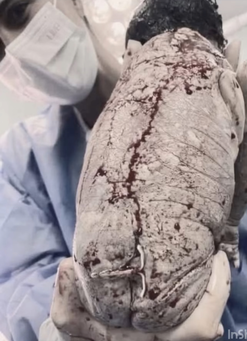 Baby born with an DIU peg…