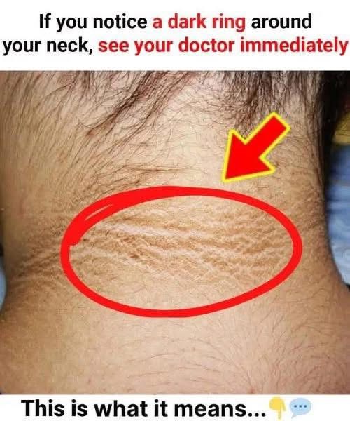 If You Notice a Dark Ring Around Your Neck, Go See Your Doctor Immediately! This Is What It Means