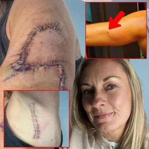 She Thought It Was Just A Mole… 77 Stitches Later, Doctors Told Her The Truth…