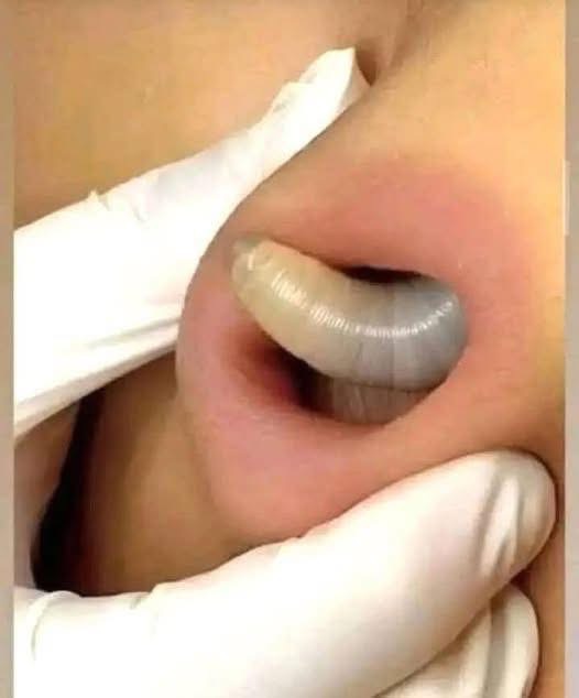 Larvae found in a young woman…See more