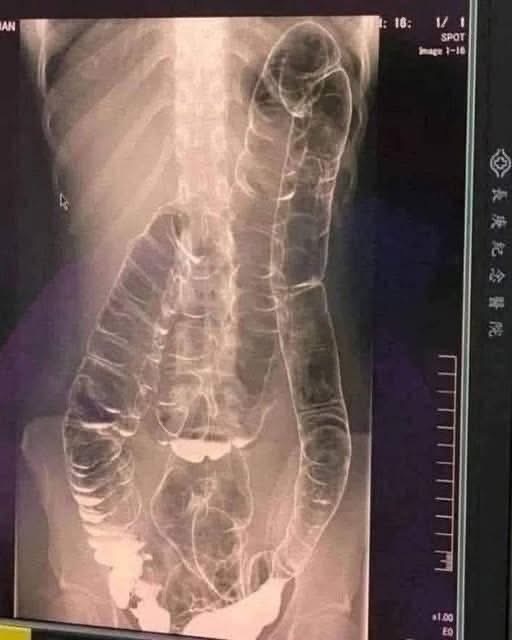 Severe Constipati!!!