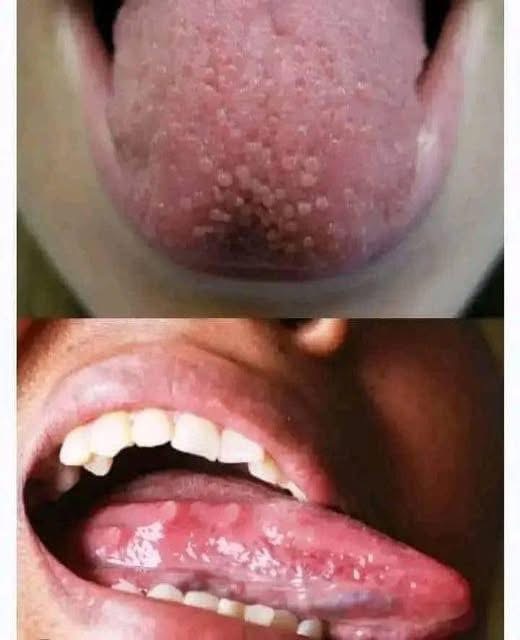 If you have pimples on your tongue, your body is warning you about something very important.