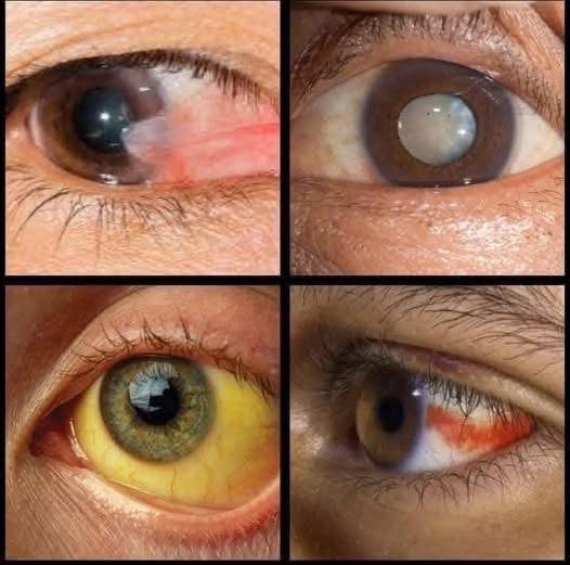 Signs in your EYES that indicate…