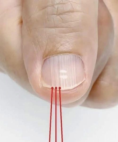 4. If You Notice These Lines on Your Nails After 40, Here’s What It Really Means Nail Ridges After 40: A Common But Overlooked Sign of Aging