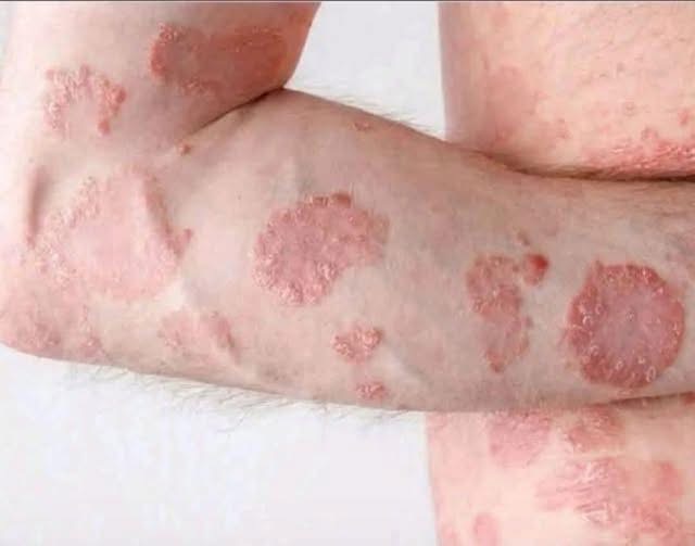 Understanding and Managing Those Painful Red Bumps
