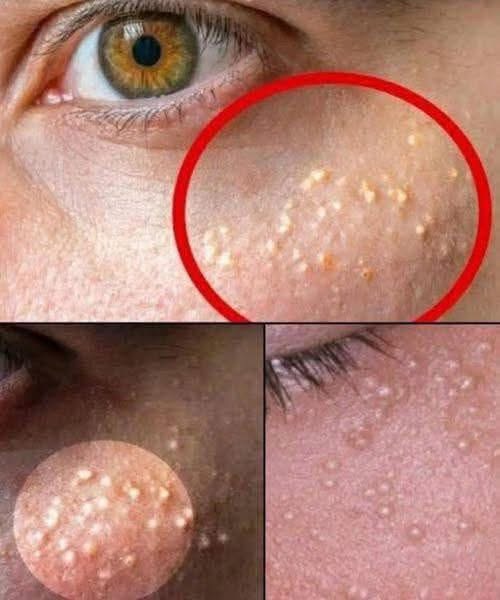 HT1. When White Bumps Appear on Your Skin, What Is Your Body Trying to Tell You?